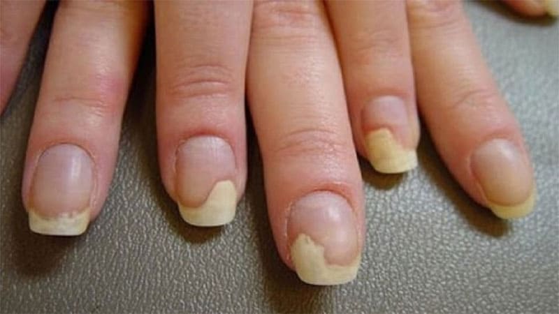 علت ایجاد قارچ در ناخن کاشت شده