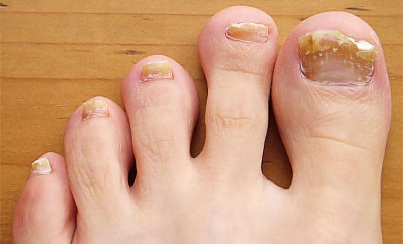 علت شکستن ناخن پا چیست؟