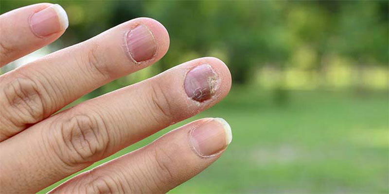 مواد حساسیت زا در کاشت ناخن